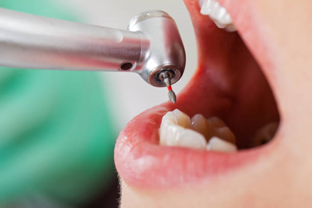 Best Emergency Dentist for Lost Fillings or Crowns in Bourbon, IN
